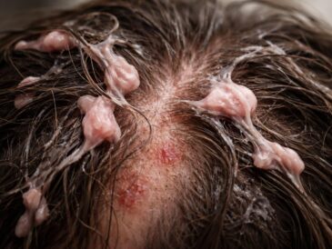découvrez les effets inattendus de la gomme dans les cheveux sur la santé de votre cuir chevelu et comment y remédier efficacement.